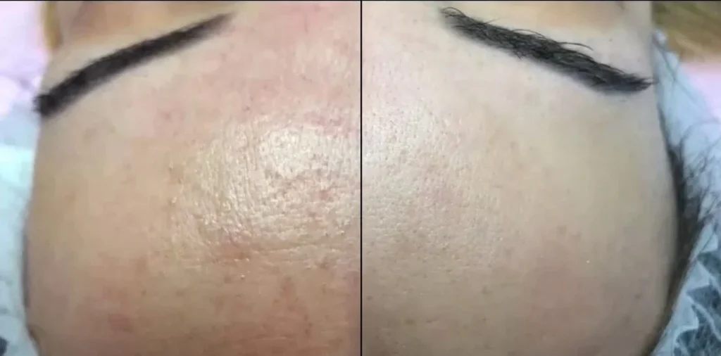 Karboksyterapia Julie w Studio Beauty Plan.
