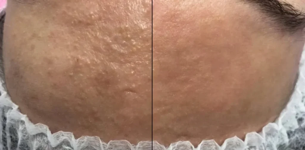 Karboksyterapia Julie w Studio Beauty Plan.