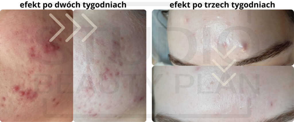 Terapie skór problematycznych w Studio Beauty Plan.